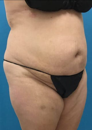 BodyTite Before & After Gallery - Patient 46612814 - Image 4