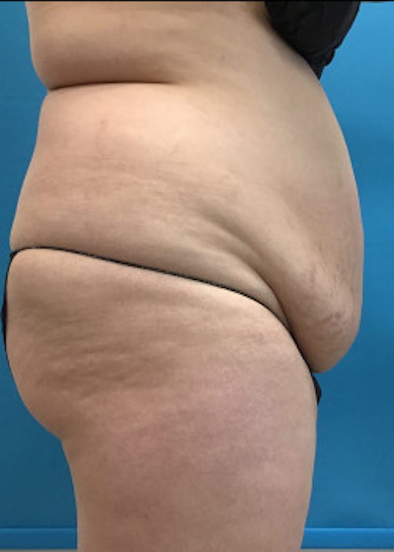 BodyTite Before & After Gallery - Patient 46612814 - Image 5