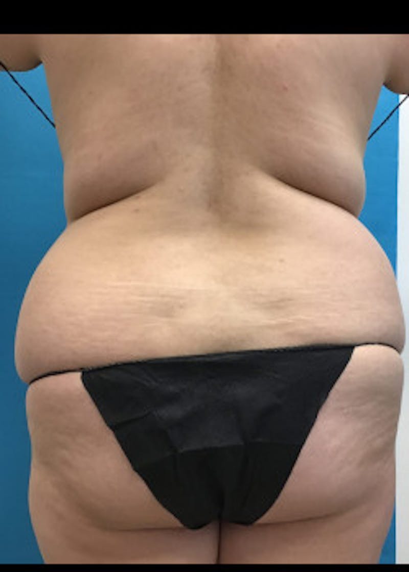 BodyTite Before & After Gallery - Patient 46612814 - Image 7