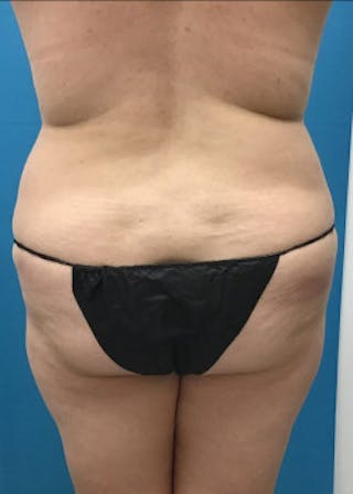 BodyTite Before & After Gallery - Patient 46612814 - Image 8