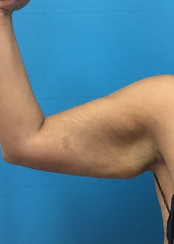 Arm Lift