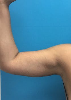 Arm Lift