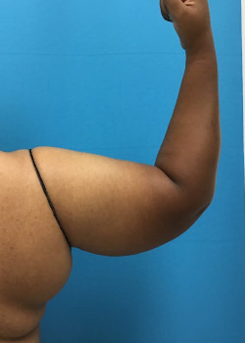 Arm Lift Before & After Gallery - Patient 46612921 - Image 1