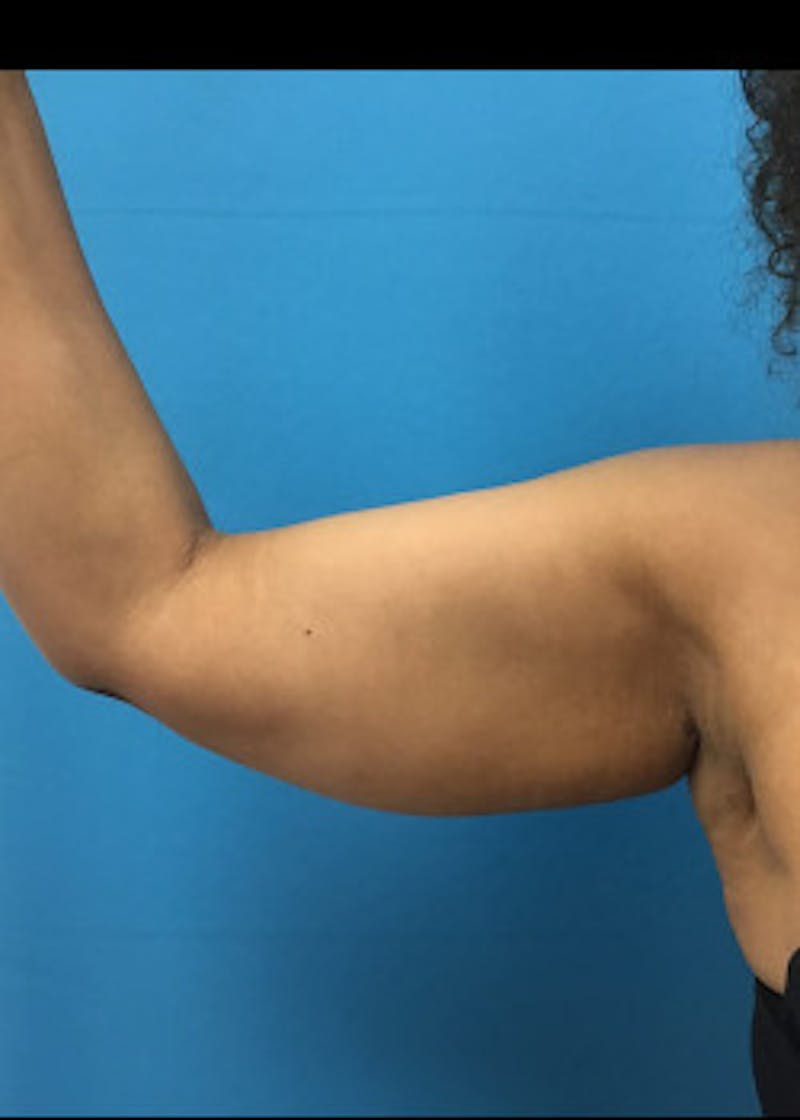 Arm Lift Before & After Gallery - Patient 46612952 - Image 1