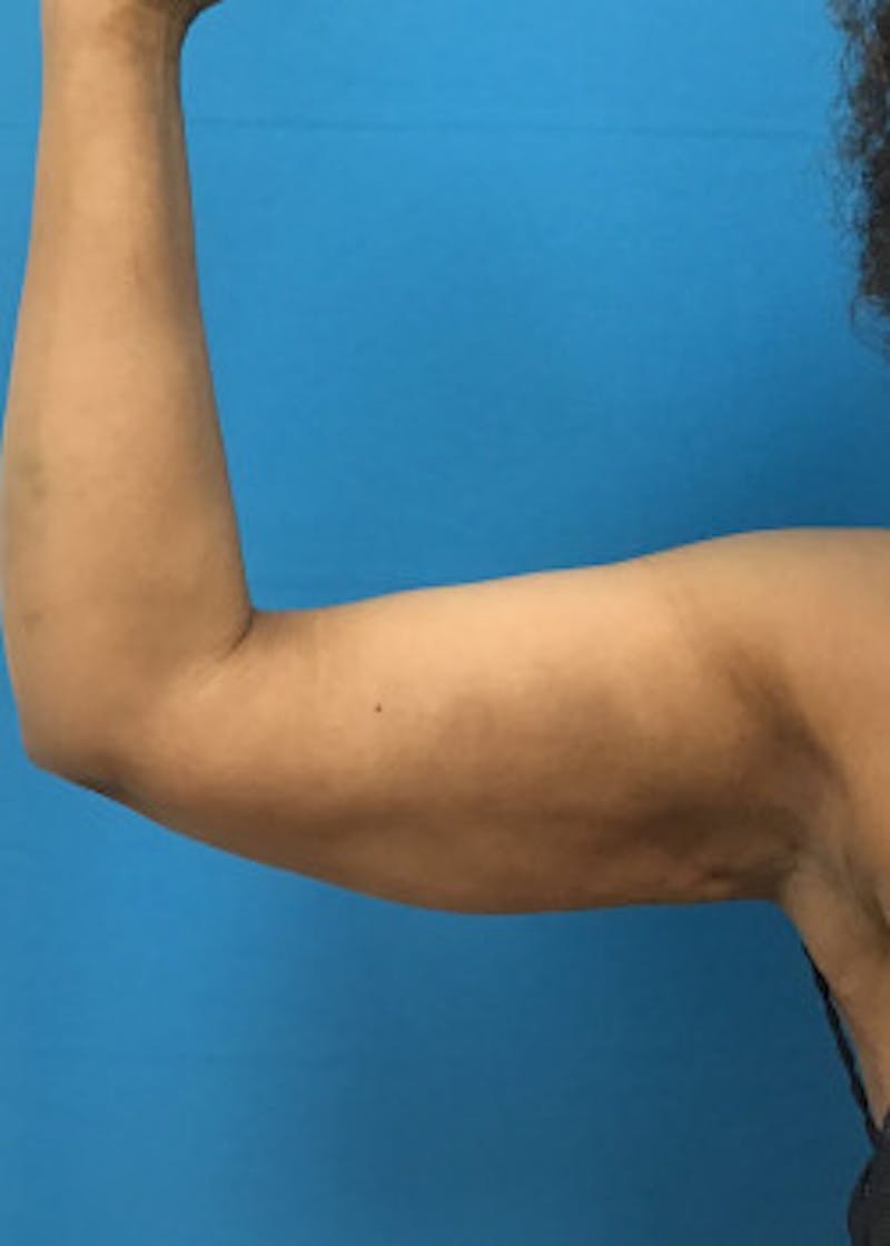 Arm Lift Before & After Gallery - Patient 46612952 - Image 2