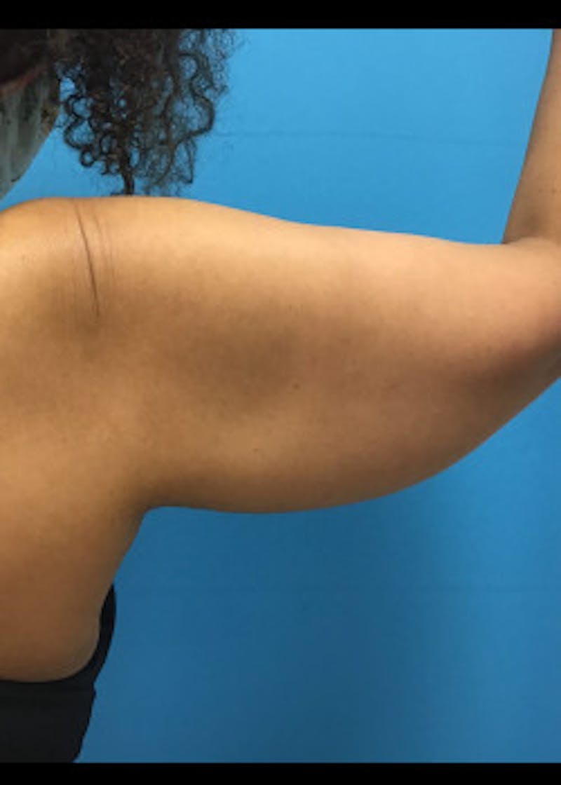 Arm Lift Before & After Gallery - Patient 46612952 - Image 3