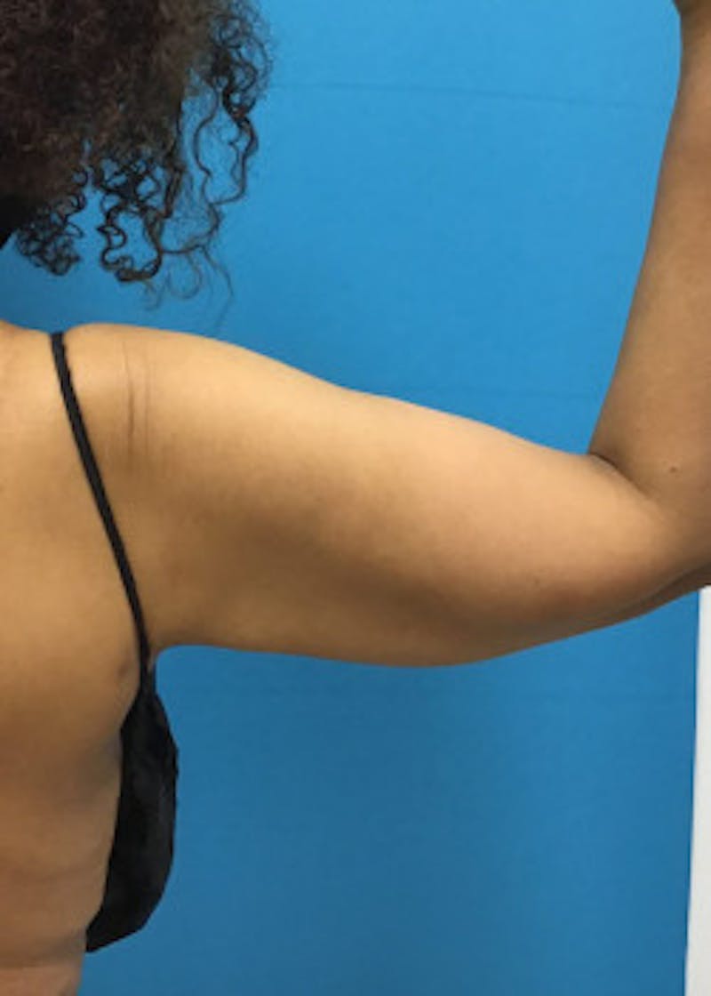 Arm Lift Before & After Gallery - Patient 46612952 - Image 4