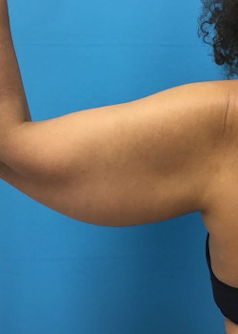 Arm Lift Before & After Gallery - Patient 46612952 - Image 5