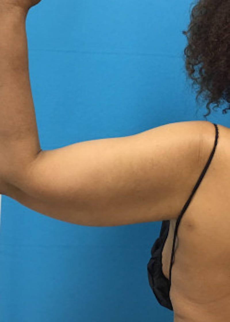 Arm Lift Before & After Gallery - Patient 46612952 - Image 6