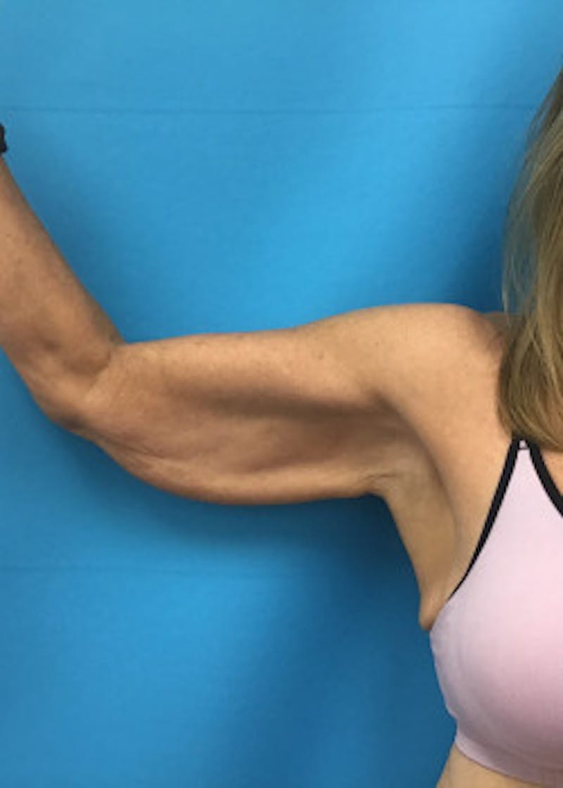 Arm Lift Before & After Gallery - Patient 46612977 - Image 1