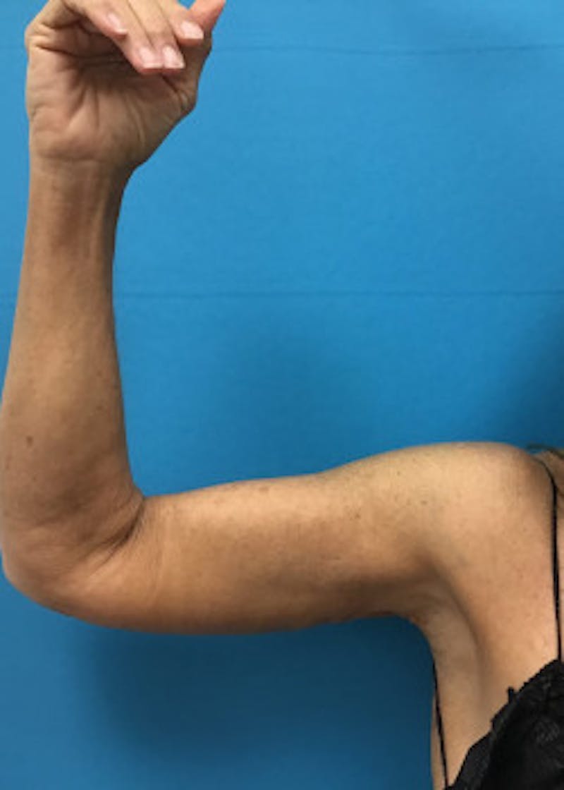 Arm Lift Before & After Gallery - Patient 46612977 - Image 2