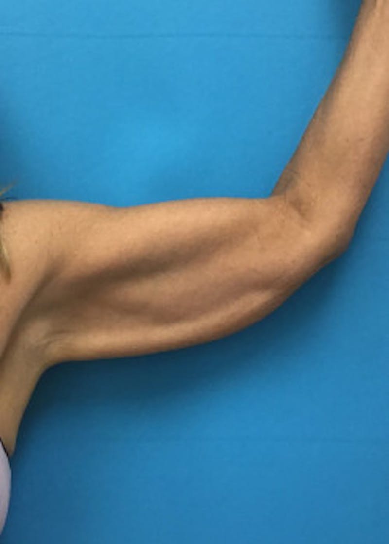 Arm Lift Before & After Gallery - Patient 46612977 - Image 3