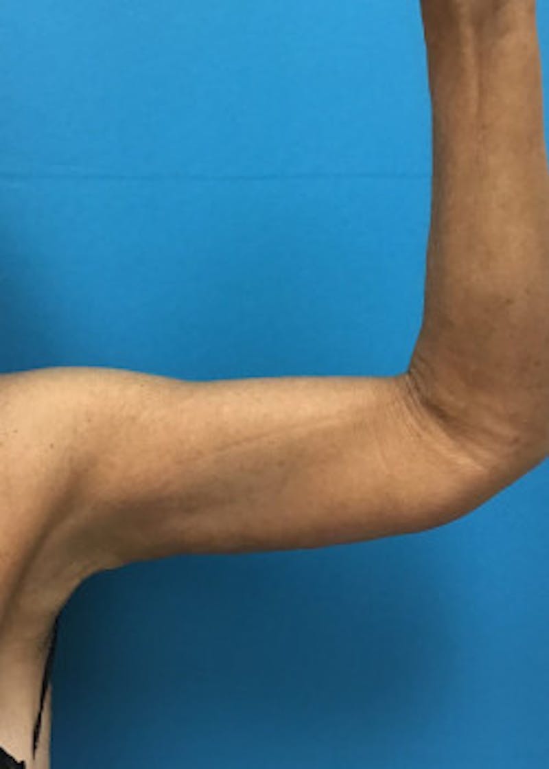Arm Lift Before & After Gallery - Patient 46612977 - Image 4