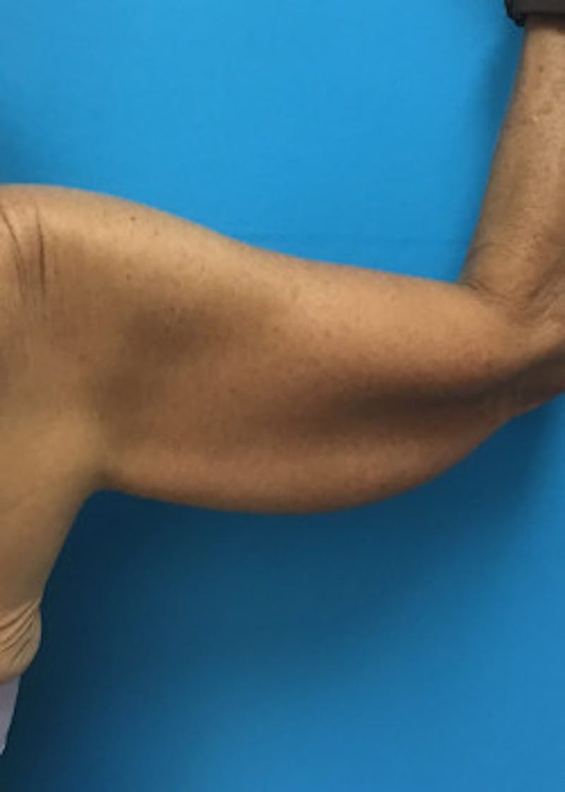 Arm Lift Before & After Gallery - Patient 46612977 - Image 5