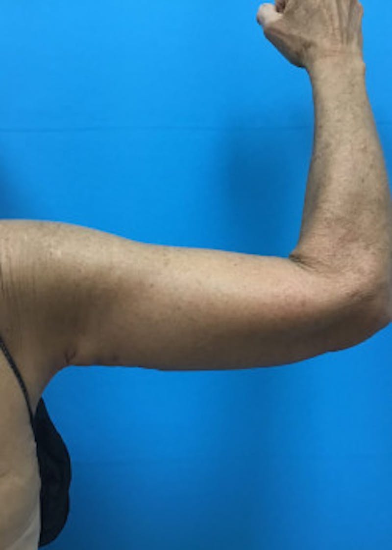 Arm Lift Before & After Gallery - Patient 46612977 - Image 6