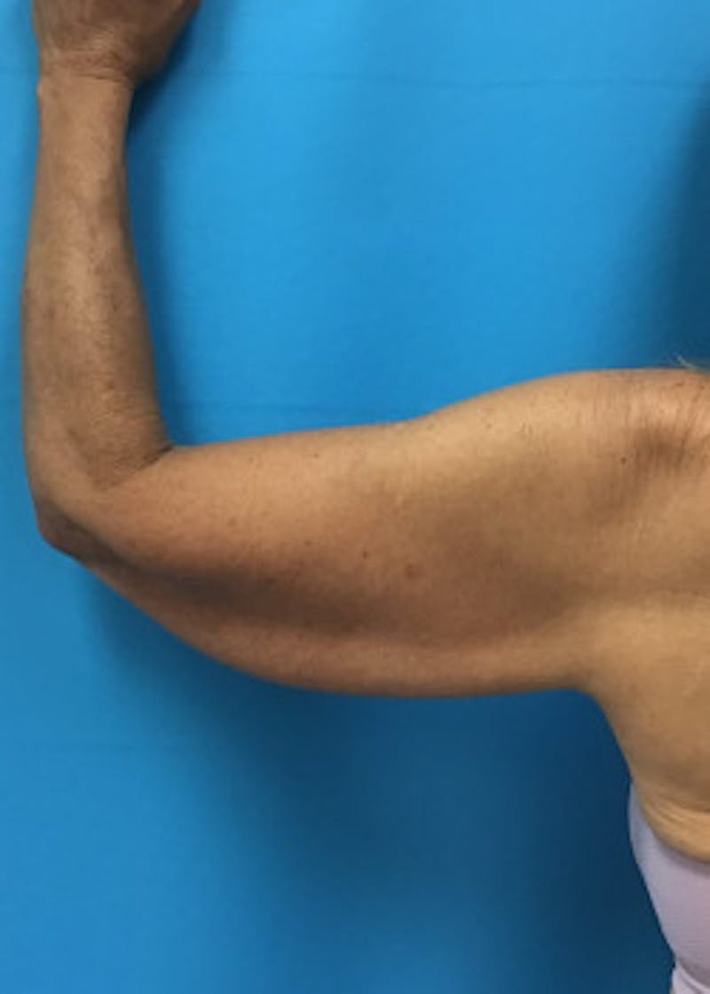 Arm Lift Before & After Gallery - Patient 46612977 - Image 7