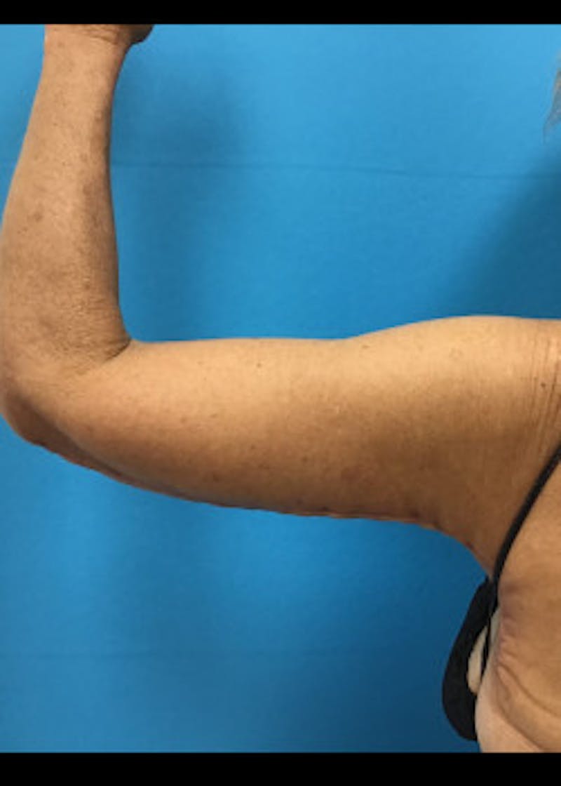 Arm Lift Before & After Gallery - Patient 46612977 - Image 8
