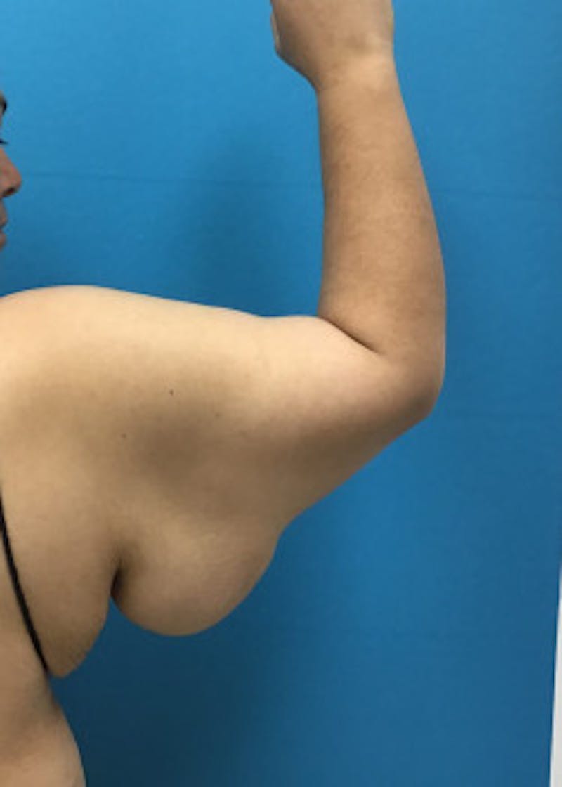 Arm Lift Before & After Gallery - Patient 46612979 - Image 1