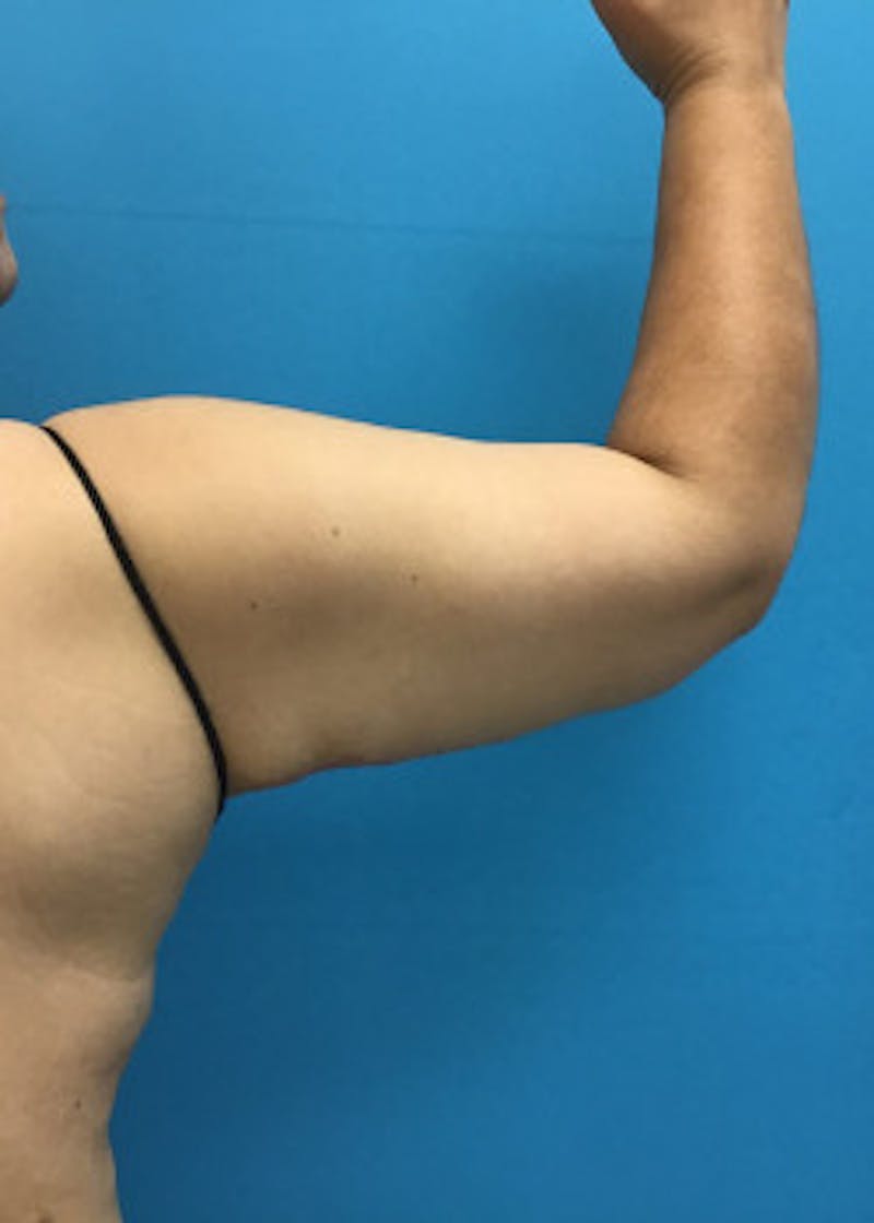 Arm Lift Before & After Gallery - Patient 46612979 - Image 2