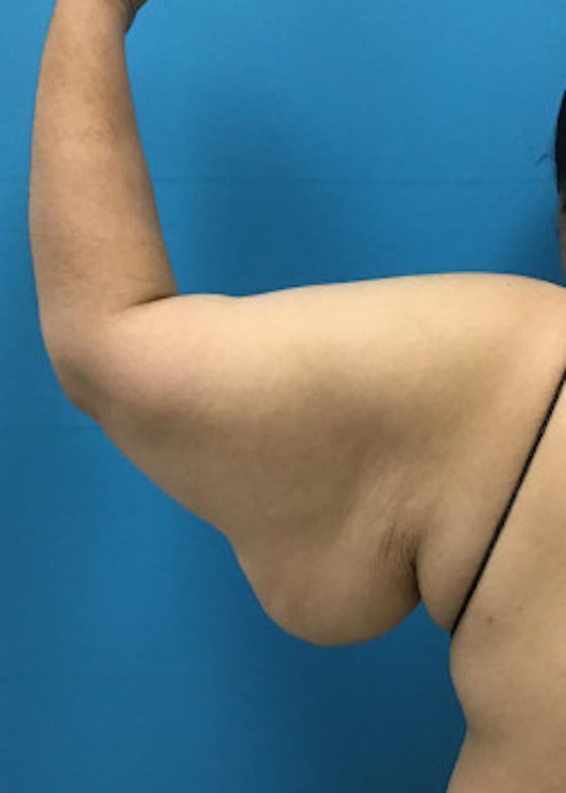 Arm Lift Before & After Gallery - Patient 46612979 - Image 3