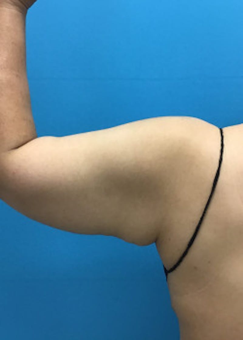 Arm Lift Before & After Gallery - Patient 46612979 - Image 4
