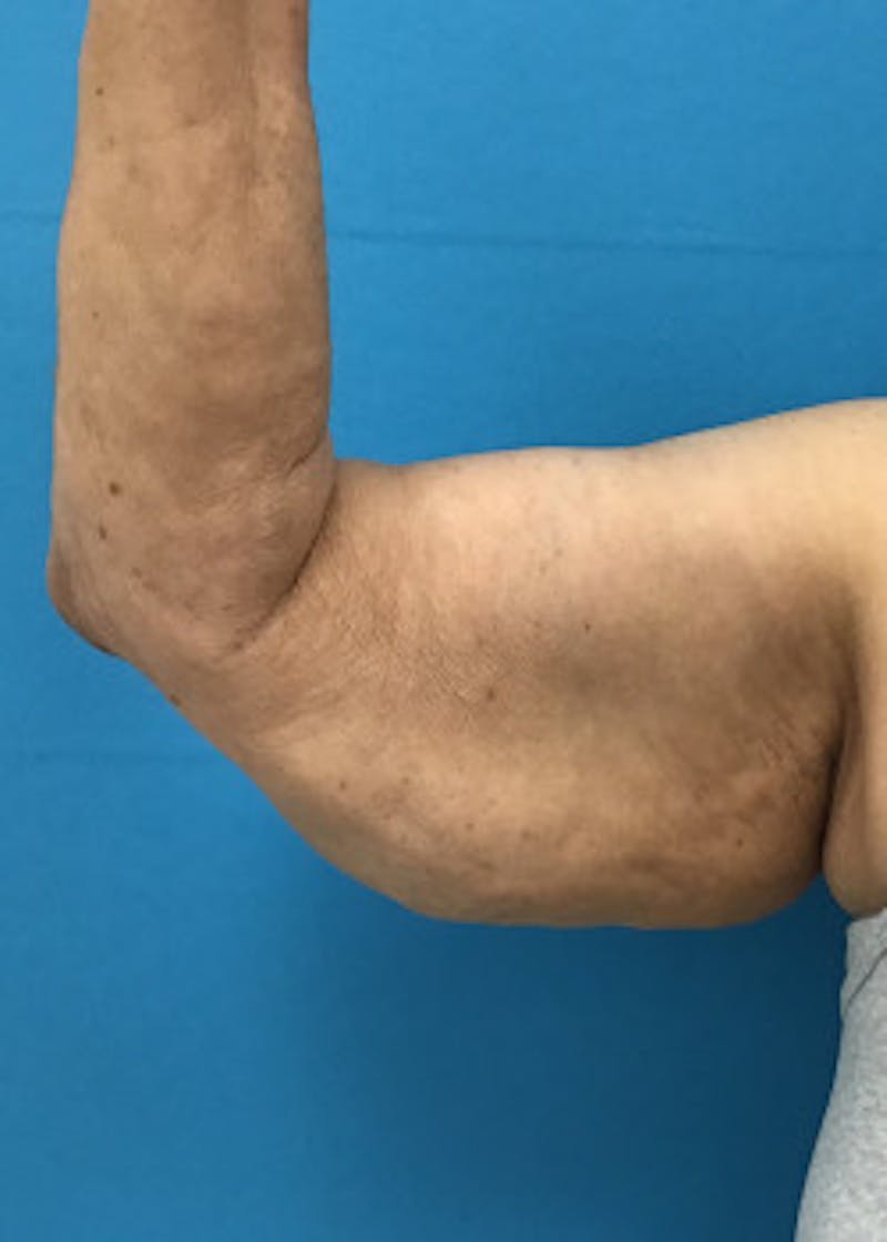 Arm Lift Before & After Gallery - Patient 46612981 - Image 1