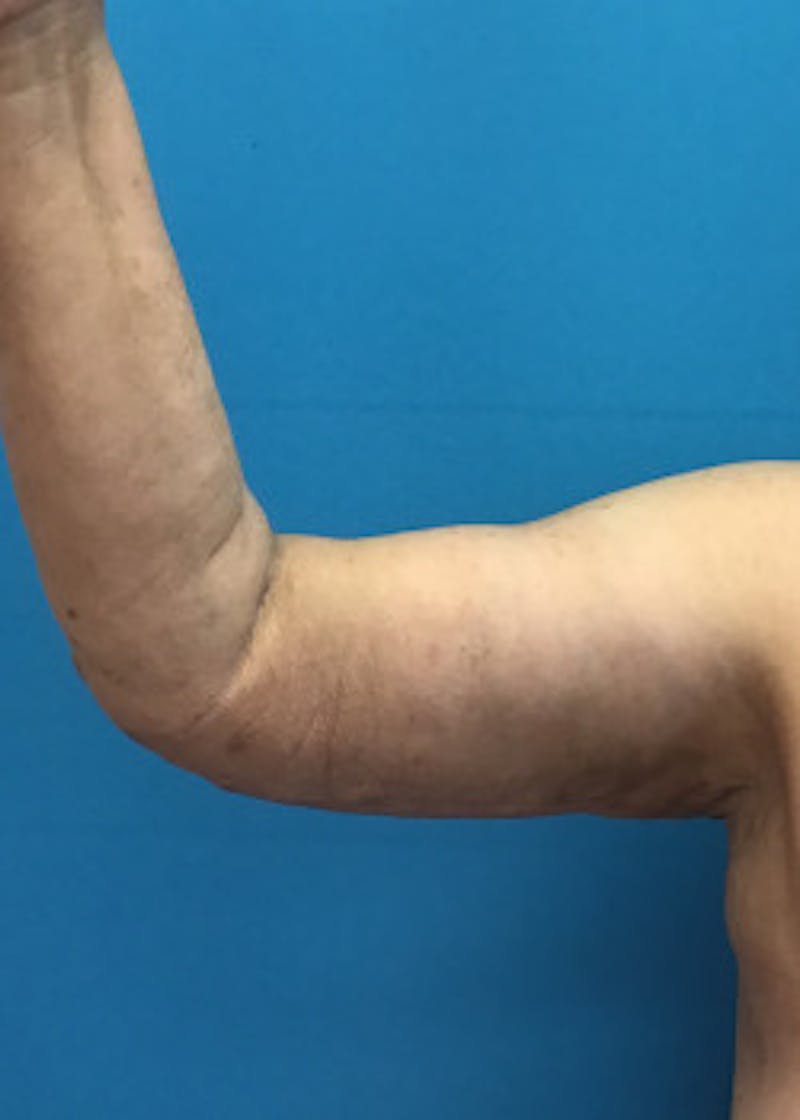 Arm Lift Before & After Gallery - Patient 46612981 - Image 2