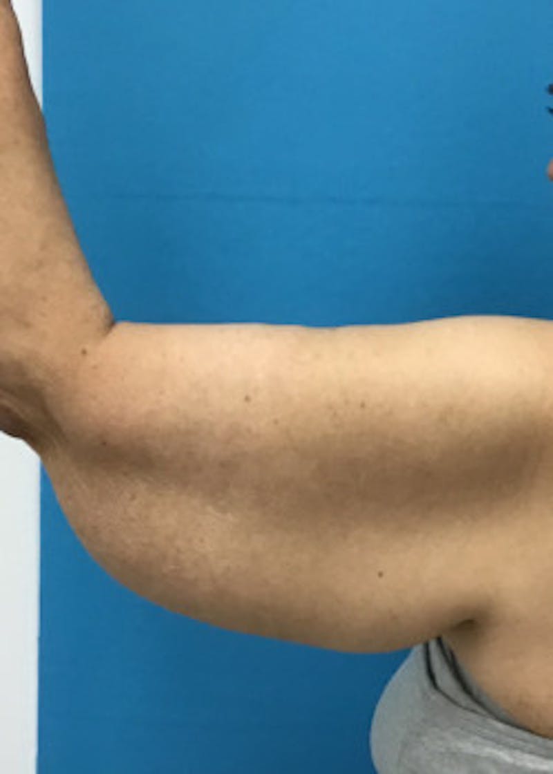 Arm Lift Before & After Gallery - Patient 46612981 - Image 3