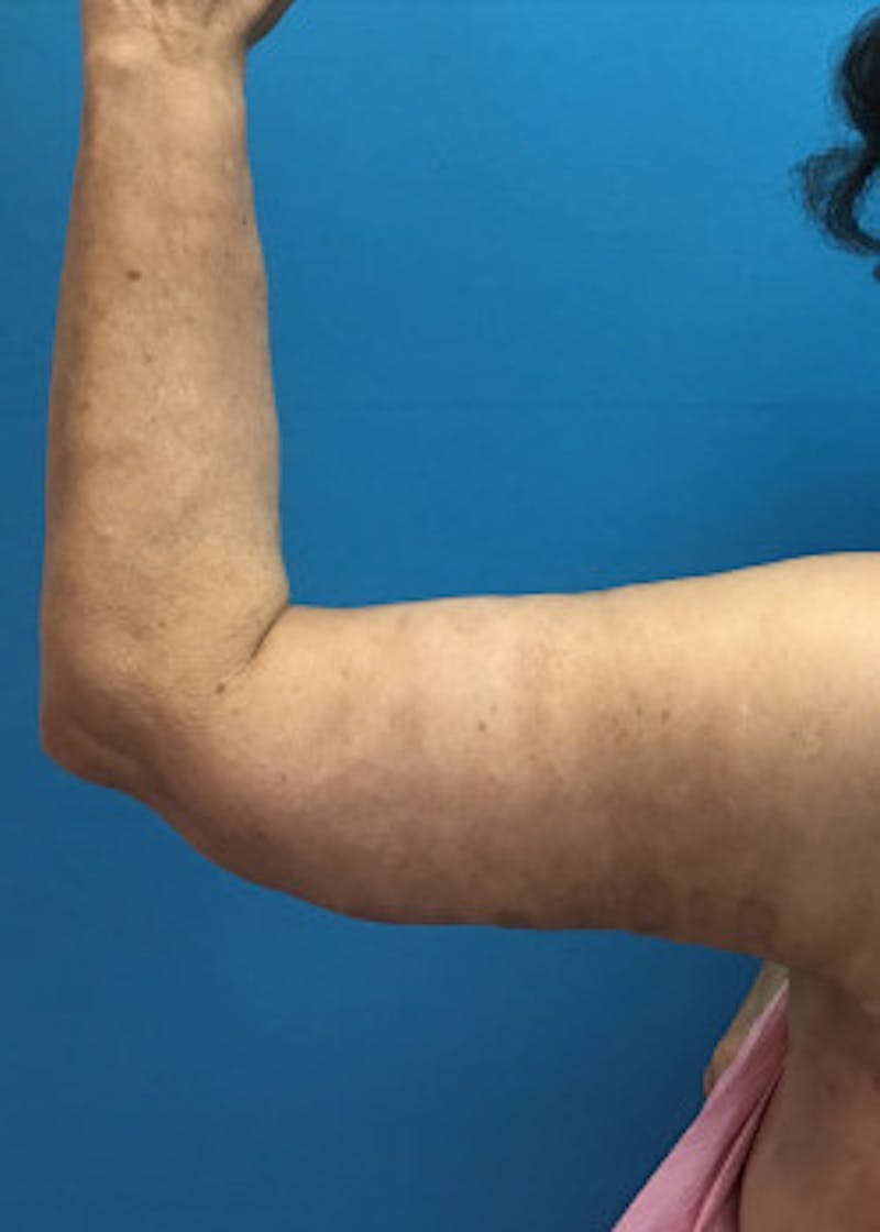 Arm Lift Before & After Gallery - Patient 46612981 - Image 4