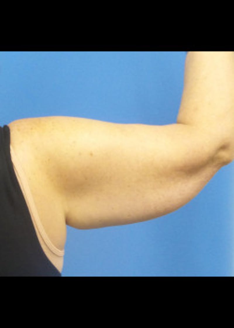 Arm Lift Before & After Gallery - Patient 46612982 - Image 1
