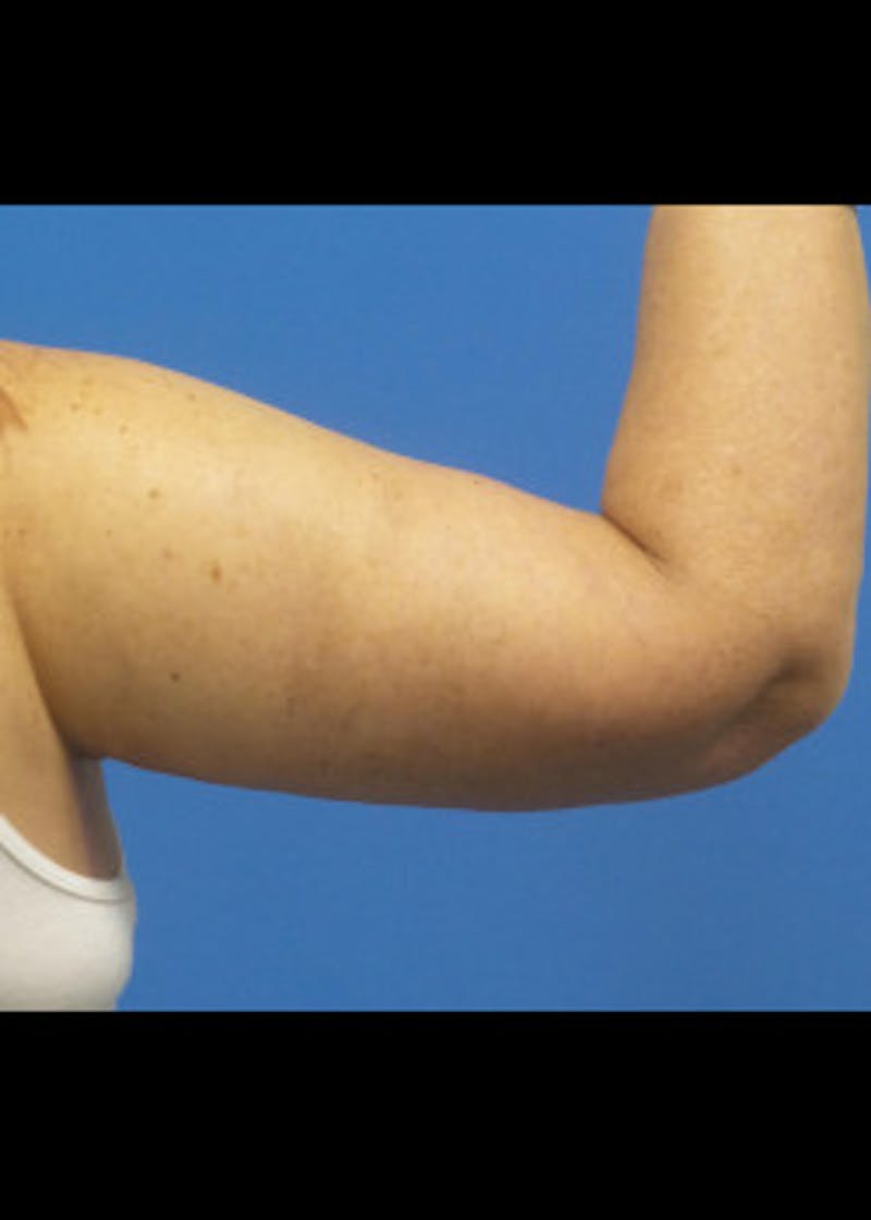 Arm Lift Before & After Gallery - Patient 46612982 - Image 2