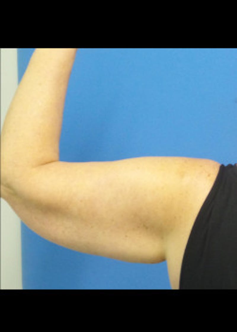 Arm Lift Before & After Gallery - Patient 46612982 - Image 3