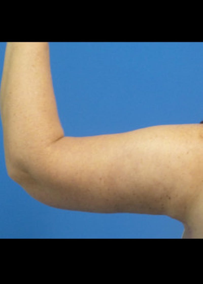 Arm Lift Before & After Gallery - Patient 46612982 - Image 4