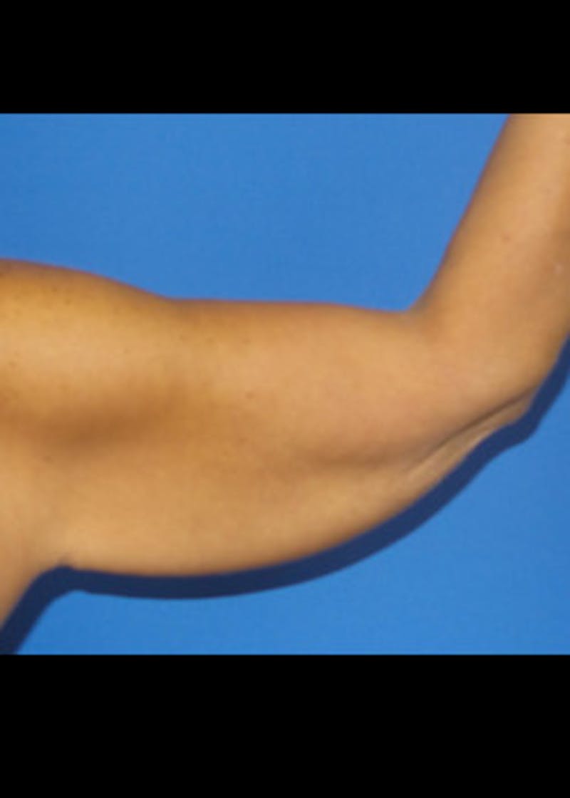 Arm Lift Before & After Gallery - Patient 46612983 - Image 1