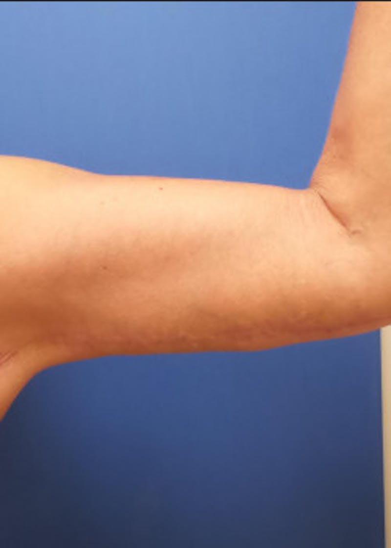 Arm Lift Before & After Gallery - Patient 46612983 - Image 2