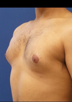 Male Breast Reduction