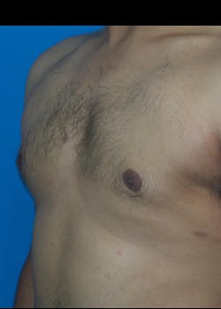 Male Breast Reduction