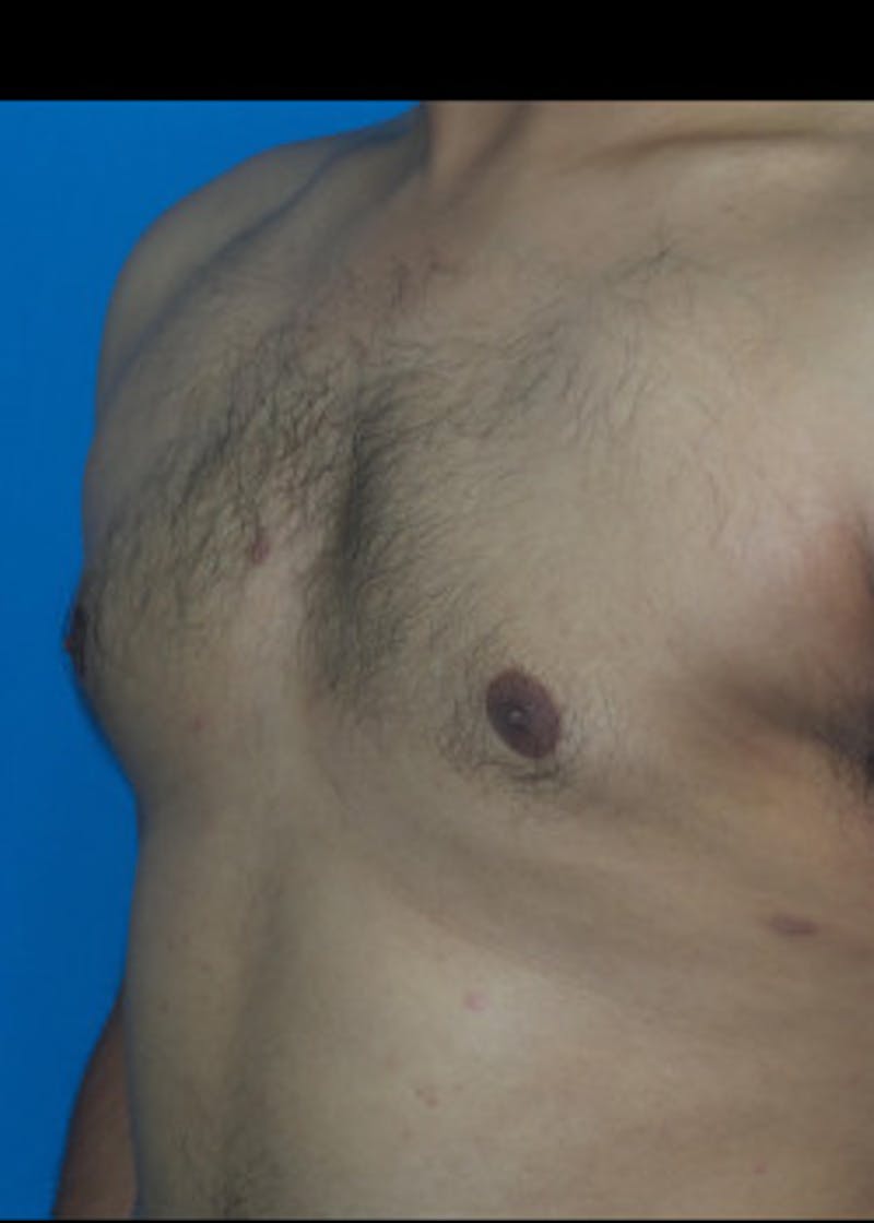Gynecomastia Before & After Gallery - Patient 46612997 - Image 2