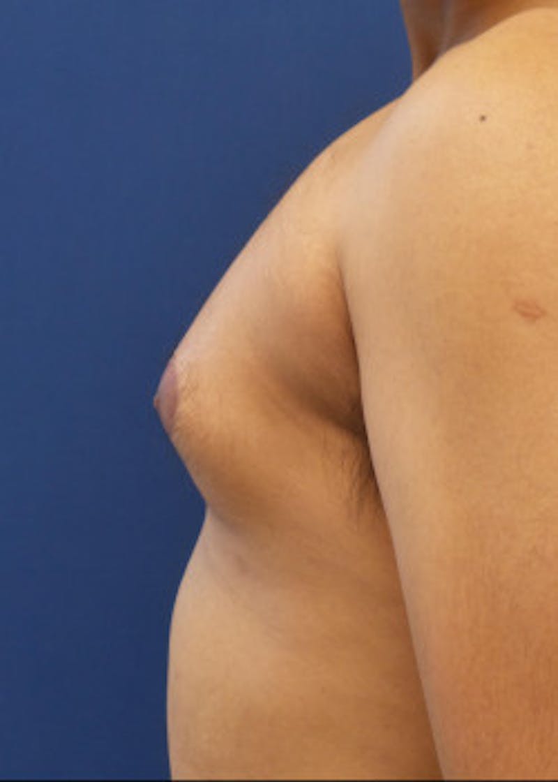 Gynecomastia Before & After Gallery - Patient 46612997 - Image 3