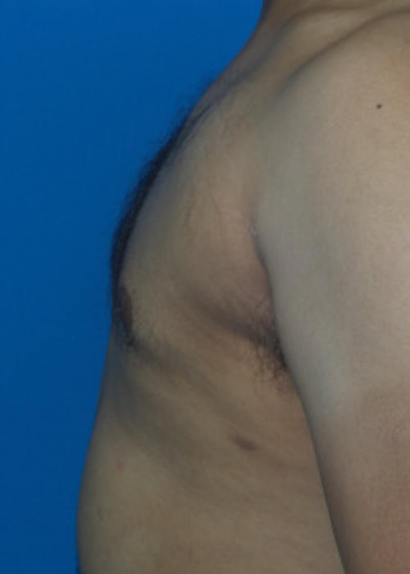 Gynecomastia Before & After Gallery - Patient 46612997 - Image 4