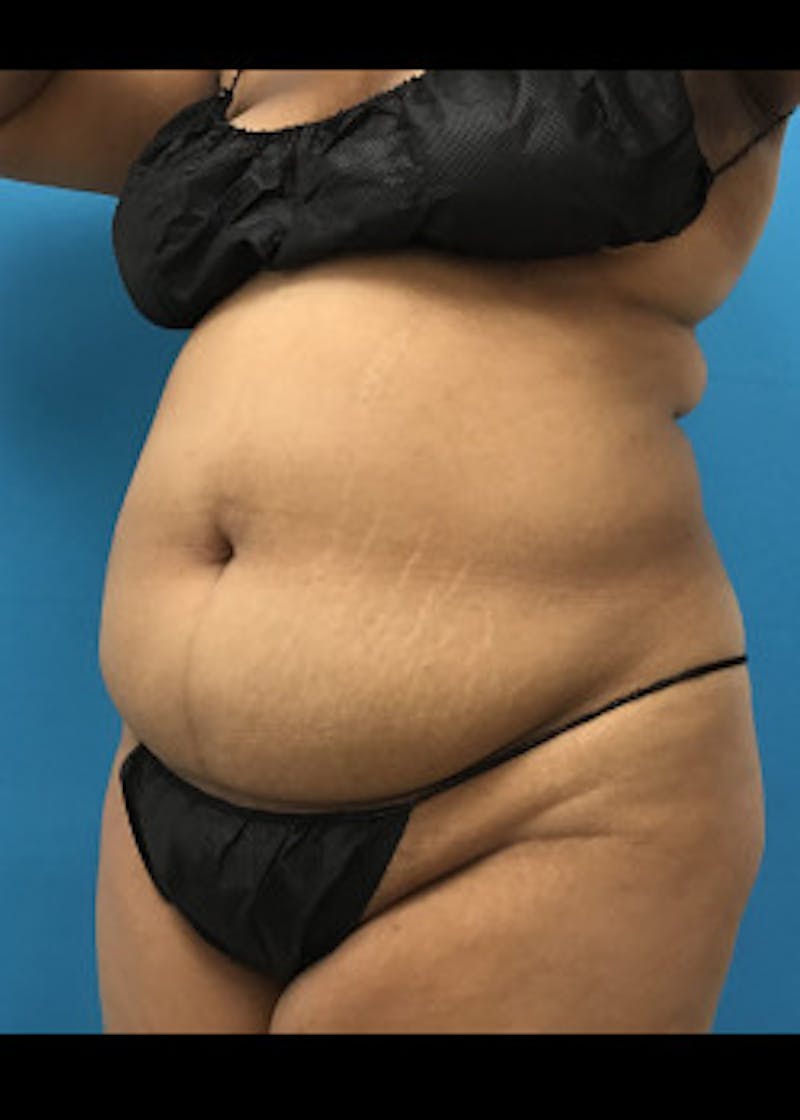 Liposuction Before & After Gallery - Patient 46613004 - Image 1
