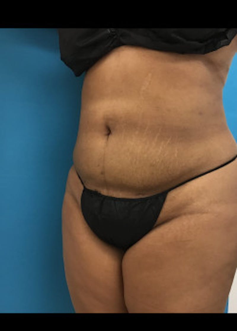 Liposuction Before & After Gallery - Patient 46613004 - Image 2