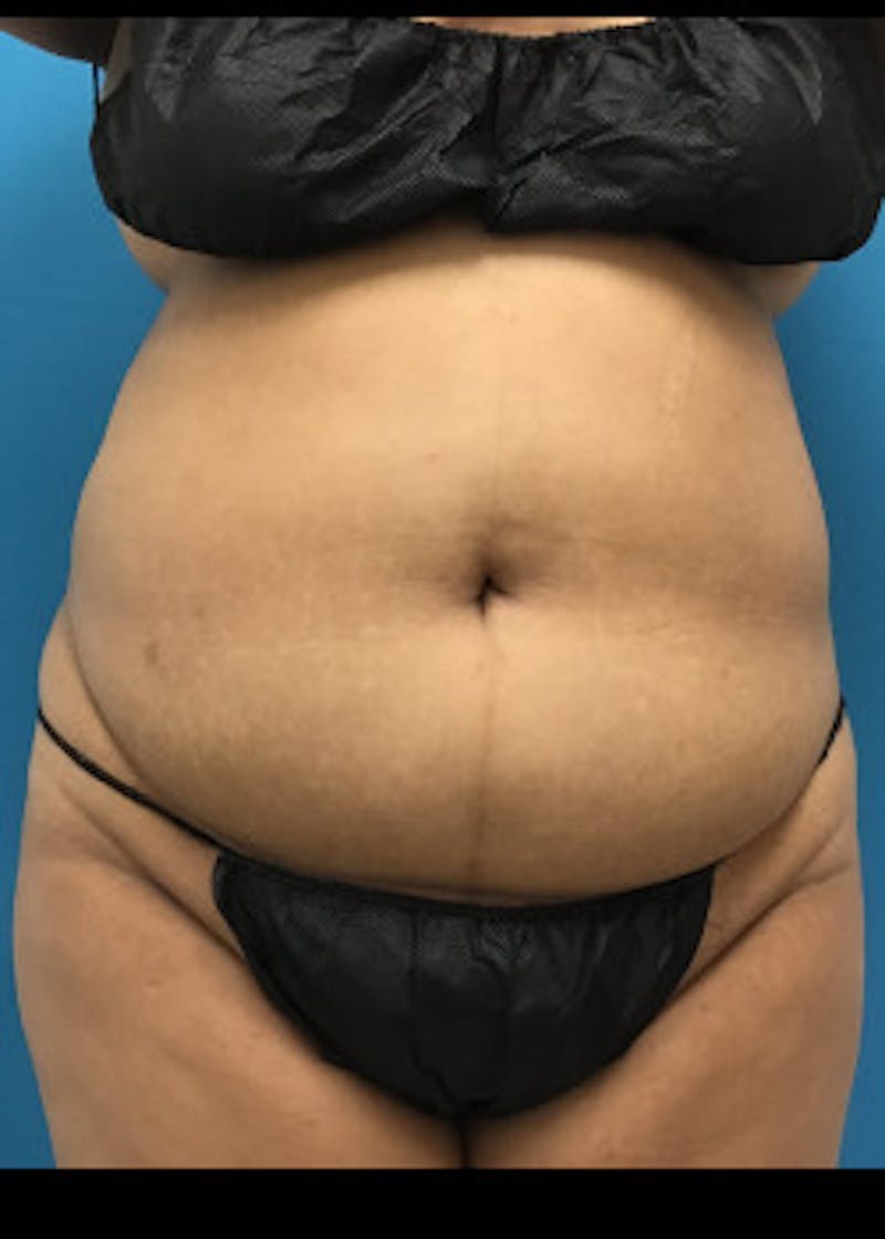 Liposuction Before & After Gallery - Patient 46613004 - Image 3