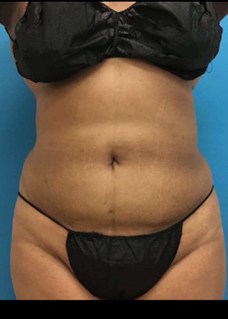 Liposuction Before & After Gallery - Patient 46613004 - Image 4