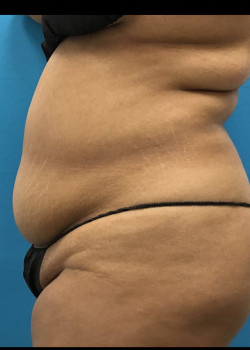 Liposuction Before & After Gallery - Patient 46613004 - Image 5