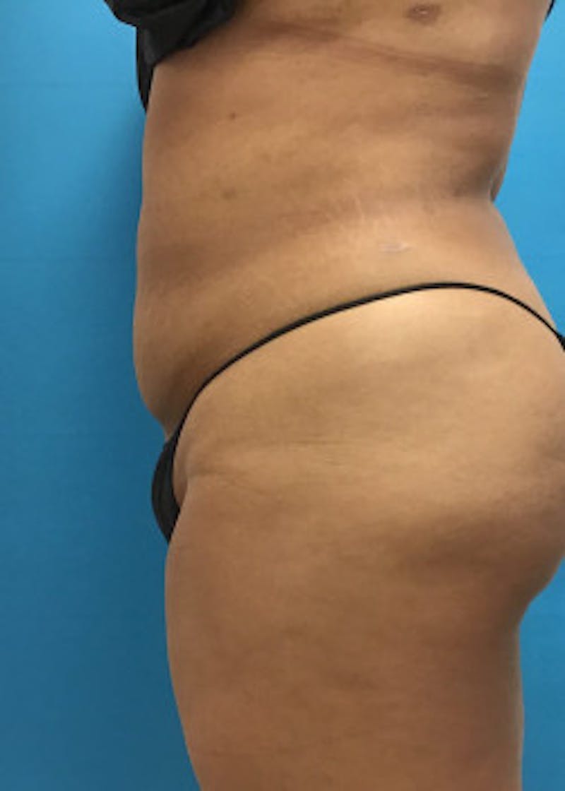 Liposuction Before & After Gallery - Patient 46613004 - Image 6