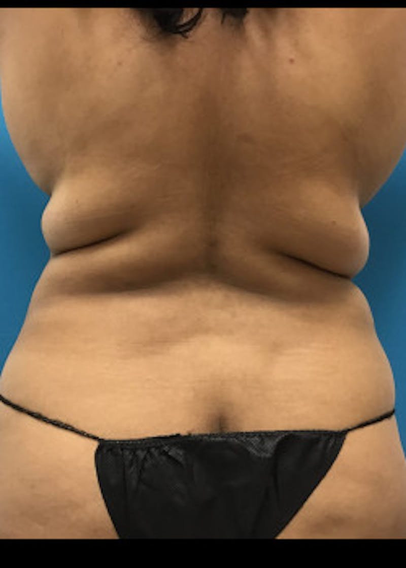 Liposuction Before & After Gallery - Patient 46613004 - Image 7