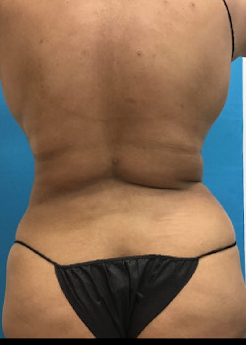 Liposuction Before & After Gallery - Patient 46613004 - Image 8