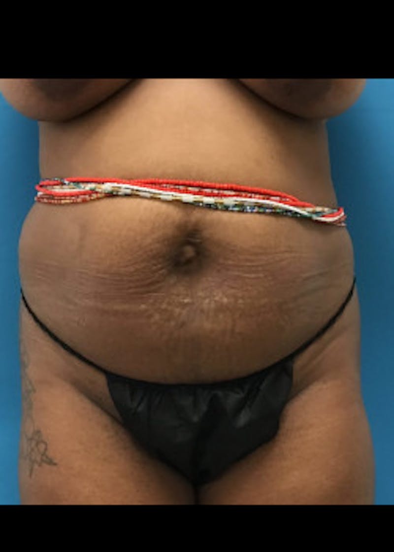 Liposuction Before & After Gallery - Patient 46613006 - Image 1