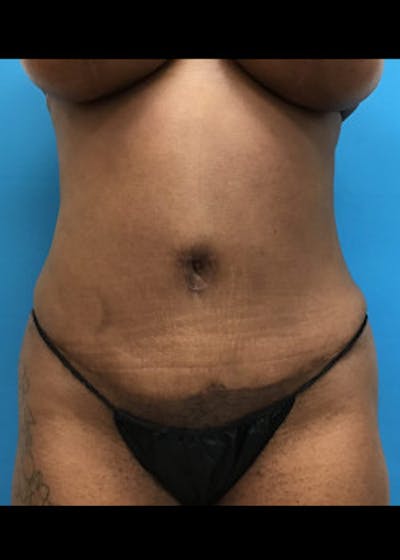 Liposuction Before & After Gallery - Patient 46613006 - Image 2